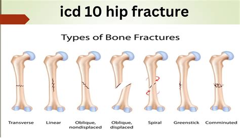 icd 10 fracture of femur|distal femur fracture icd 10.